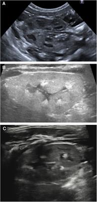 Case Report: effect of lumasiran treatment in a late preterm baby with antenatal diagnosis of primary hyperoxaluria type 1